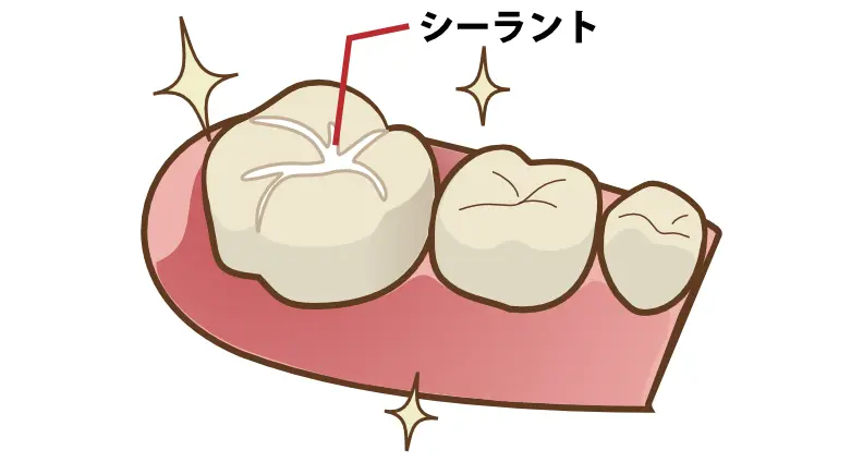 歯の溝をうめる