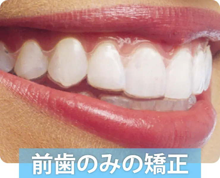 前歯のみの矯正