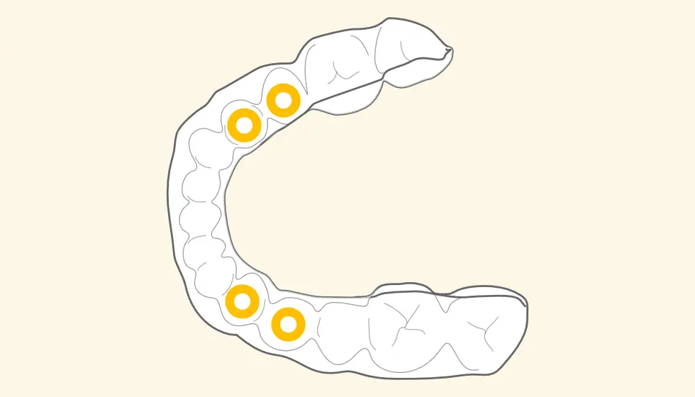 サージカルガイド