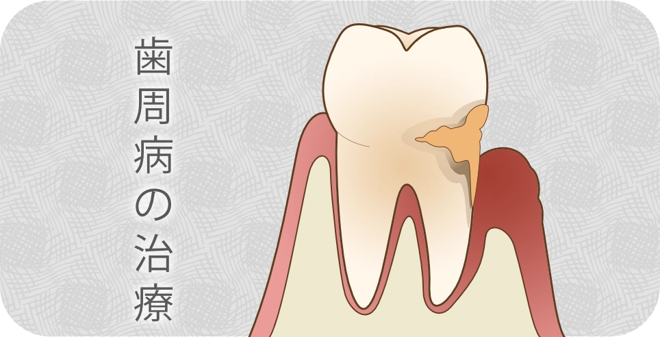 歯周病の治療